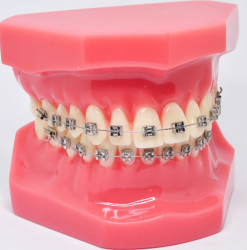 Model typodont orto roz cu bracketi metalici 
